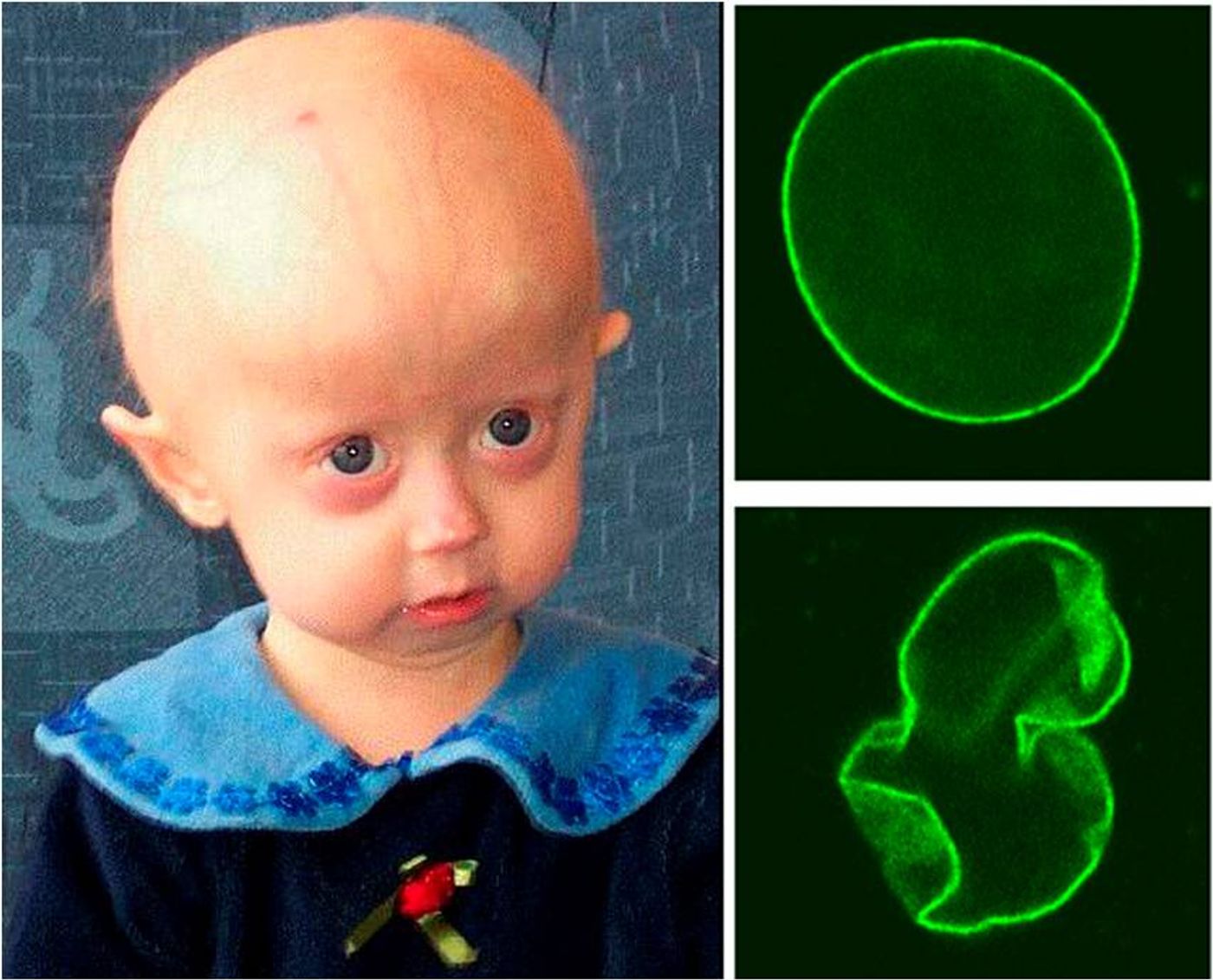 Progeria accelerates the aging process; a mutated protein weakens normal cellular structure. 
