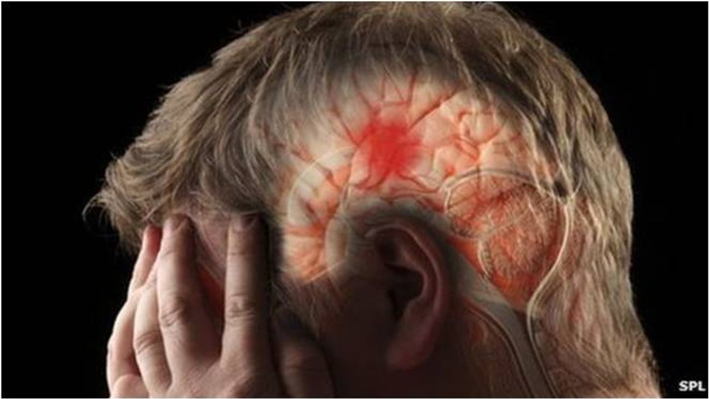 Rapid detection of ischemic strokes can save lives.