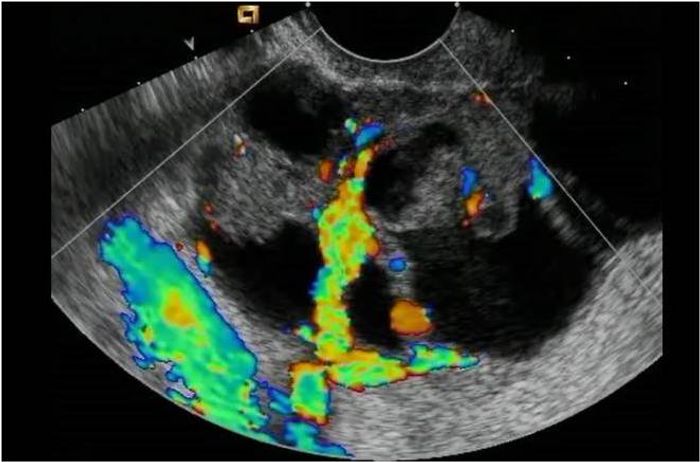 Ultrasound of ovarian cancer