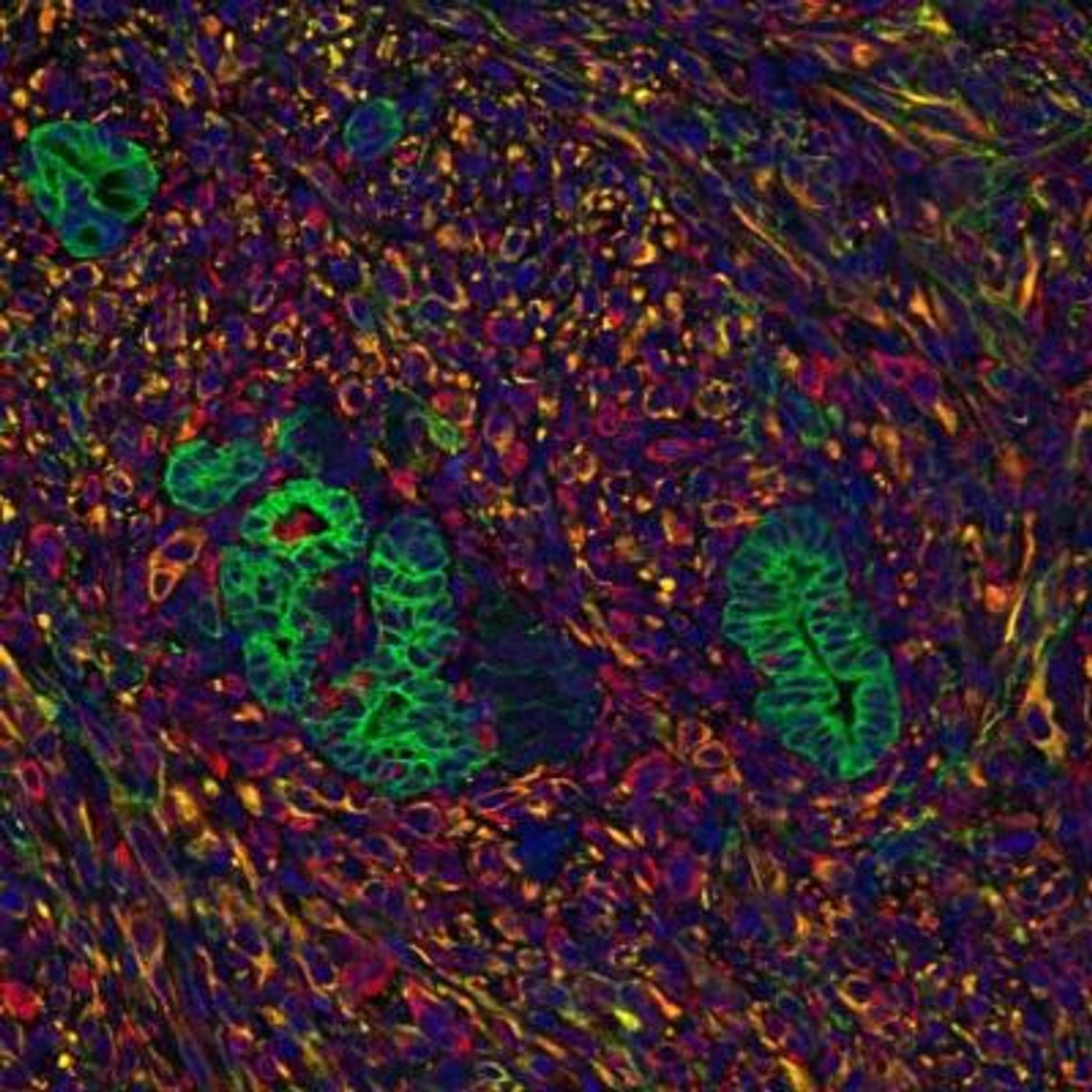 Tumor (green), stromal cells (red) | Image: Salk Institute