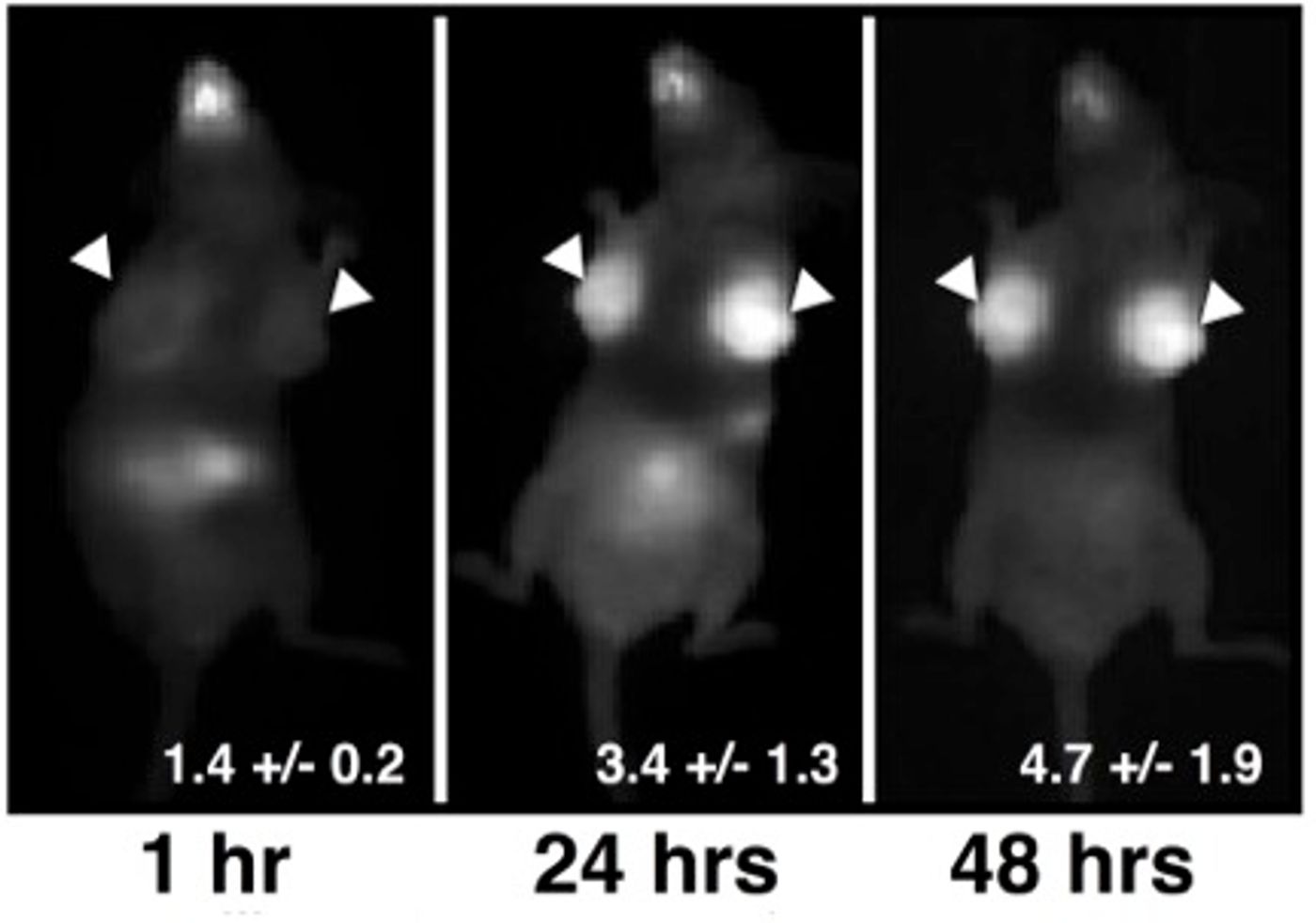 Breast cancer tumors light up with infrared light
