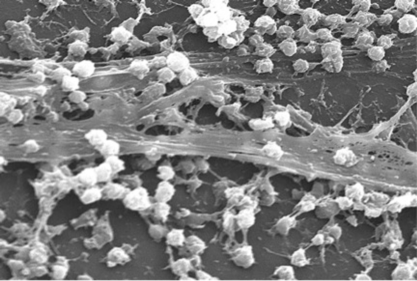 Bacterial biofilm on a indwelling catheter