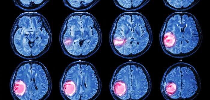 Aggressive Brain Tumor Has A Telltale Genetic Mutation Cancer