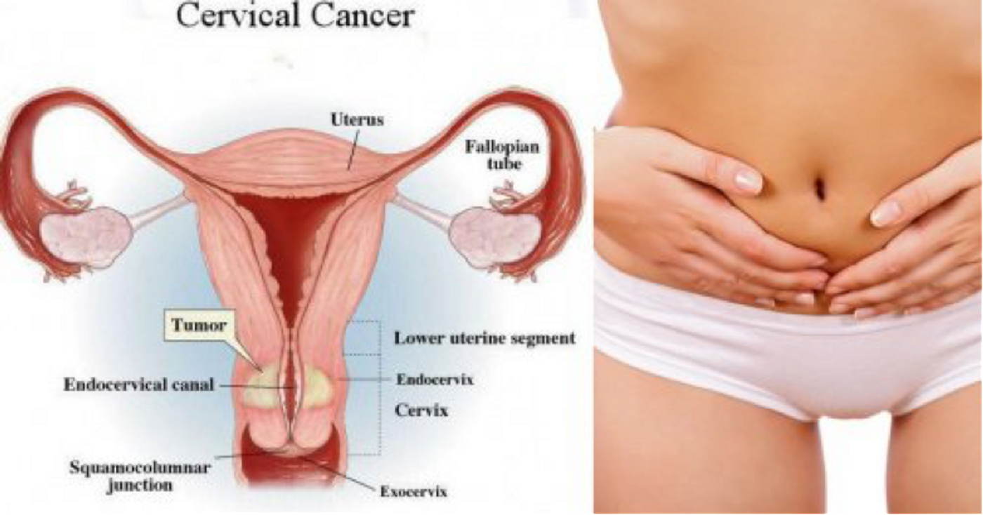 Protein discovery could lead to new drug targets for cervical cancer