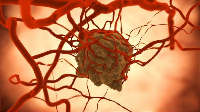 Tumor shape affects metastasis potential