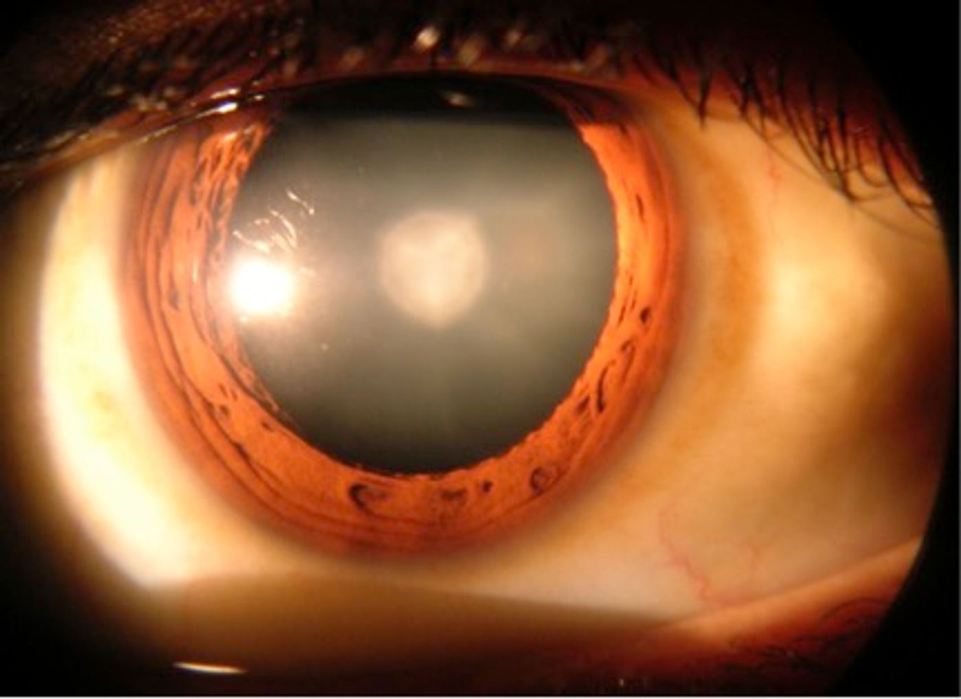 Protein buildups in the eye lens