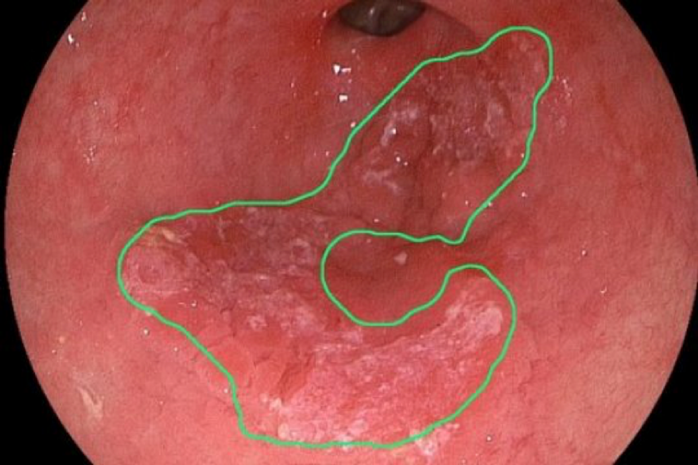 Software almost on par with top specialists in detecting esophagus cancer | Image: Eindhoven University of Technology