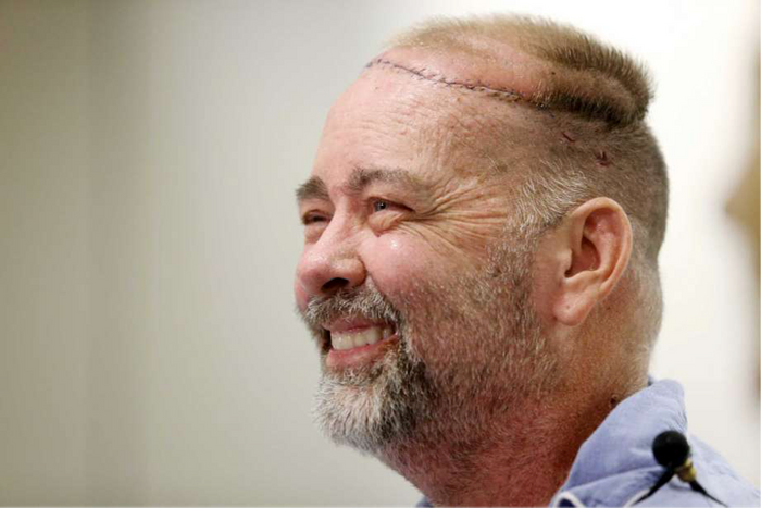 Texas man gets new skull-scalp transplant along with 2 organs