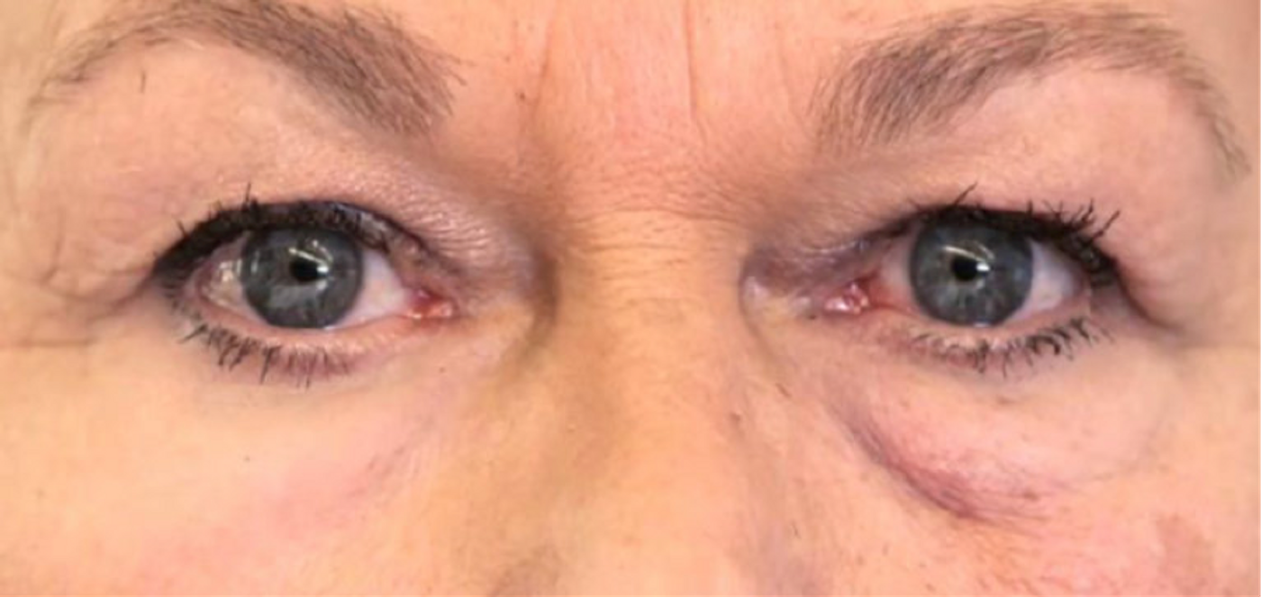 Left: skin treated XPL; Right: no treatment