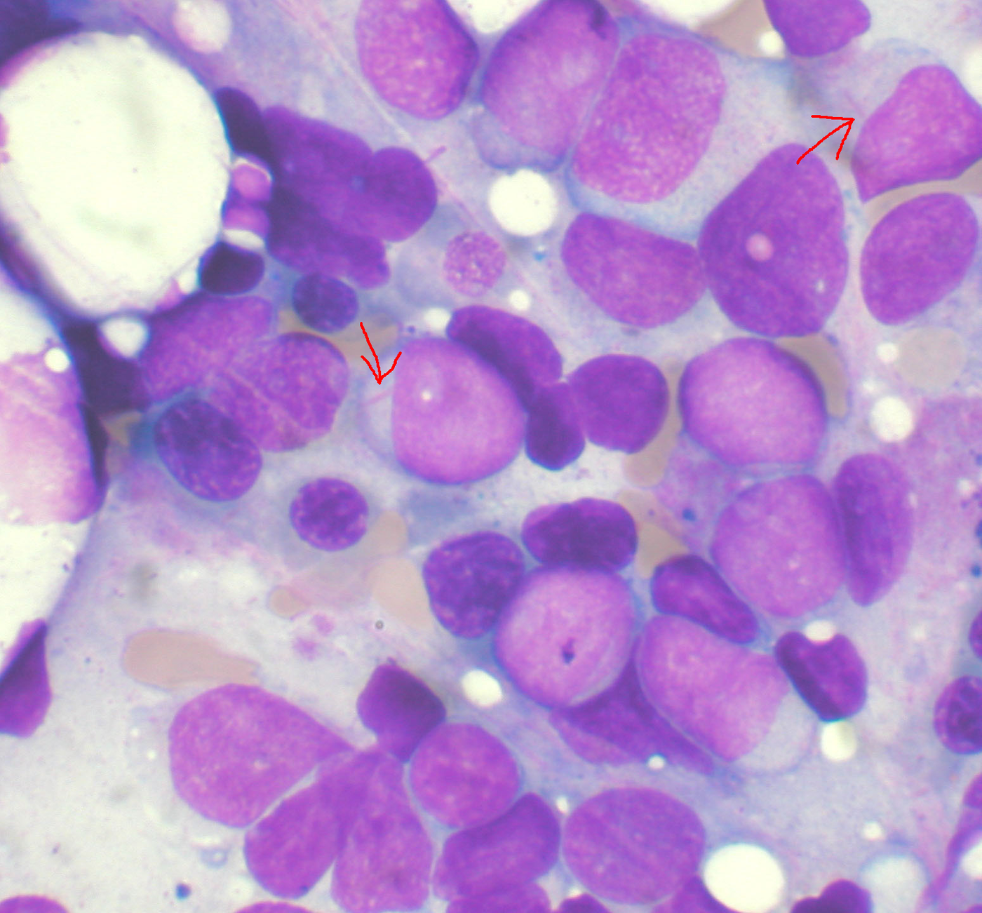 Abnormal blood cells in AML | wikimedia