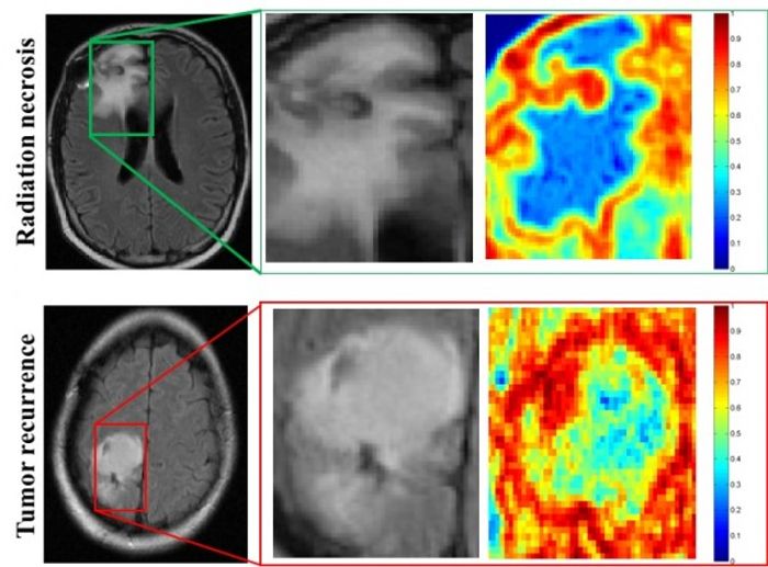 MRI scans of patients with radiation necrosis (above) and cancer recurrence (below) are shown in the left column. | Image: Tiwari Lab