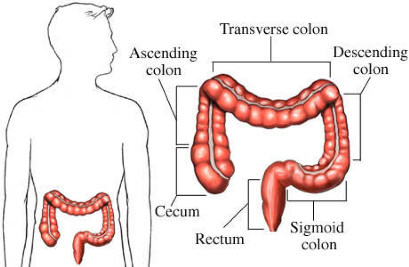 Left vs. right really matters in colon cancer 