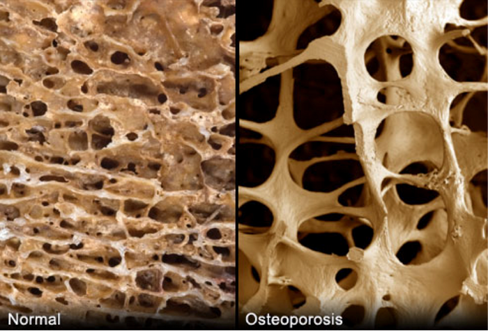 Left: normal bones. Right: bones with osteoporosis