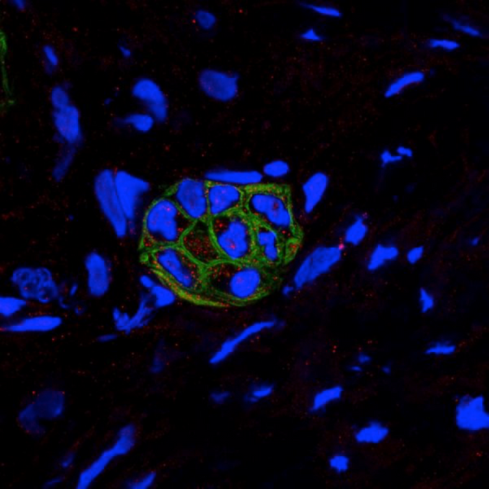 Human PDAC tumors shows co-expression of CXCL1 (red) and CK19 (green; a marker of PADC) by confocal microscopy.