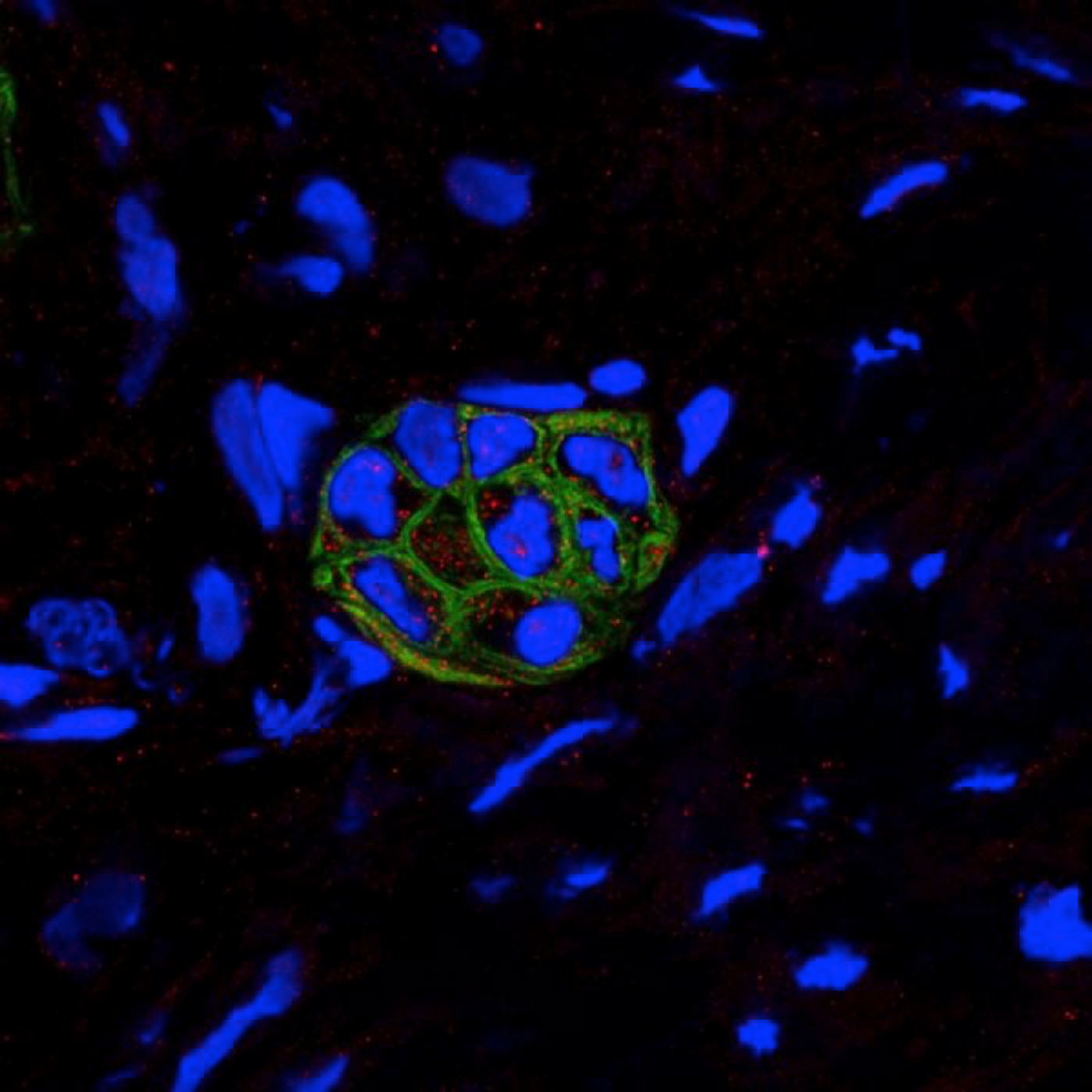 Human PDAC tumors shows co-expression of CXCL1 (red) and CK19 (green; a marker of PADC) by confocal microscopy.