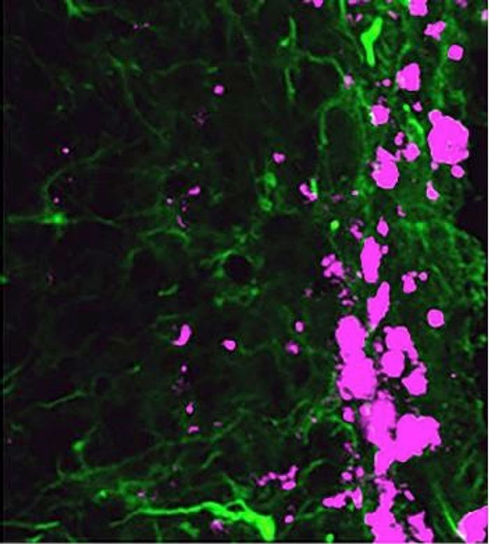 Reprogrammed stem cells (green) hunt and kill glioblastoma cells (pink)