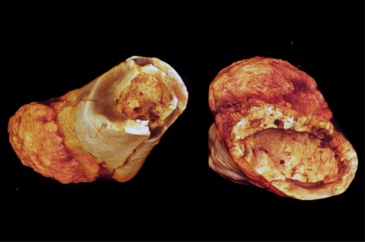 Million year old fossilized cancer in metatarsals | Image:  Edward Odes (Wits)