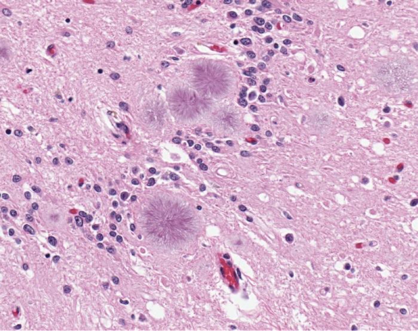 Histopathology of prion infection in the brain