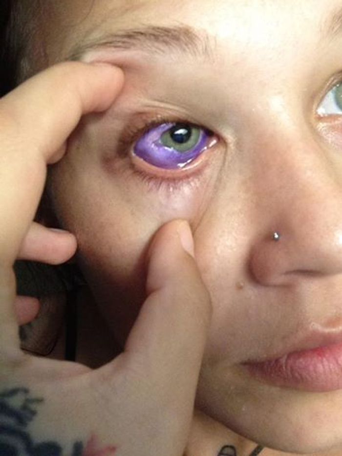 Botched Sclera Tattoo Nearly Blinds Model Clinical And Molecular Dx