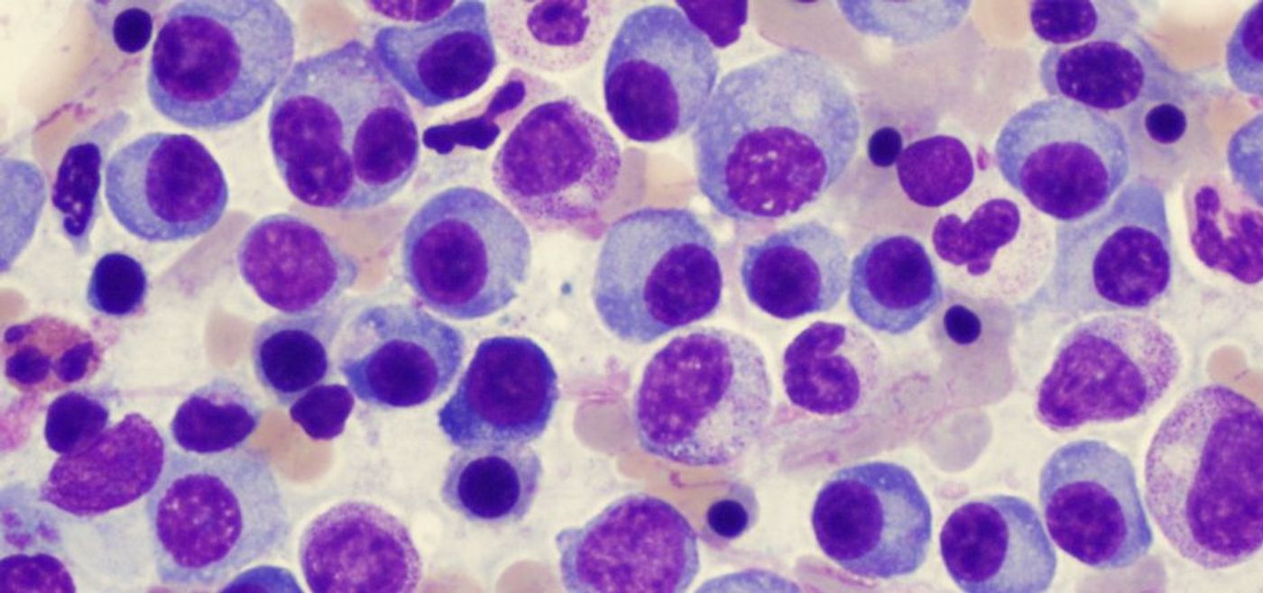 New genetic findings help explain inherited predisposition to myeloma | Image: theusbport.com