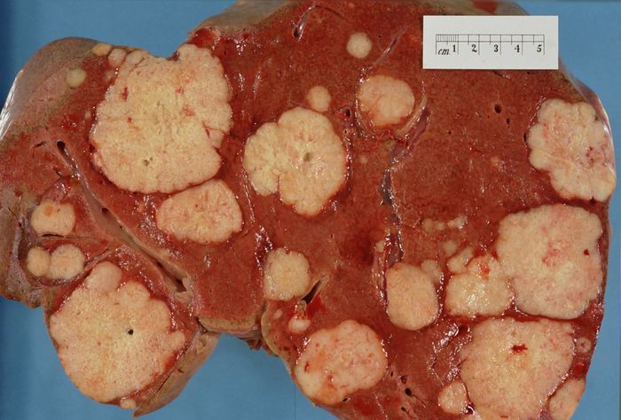 Tumor nodules in a liver.