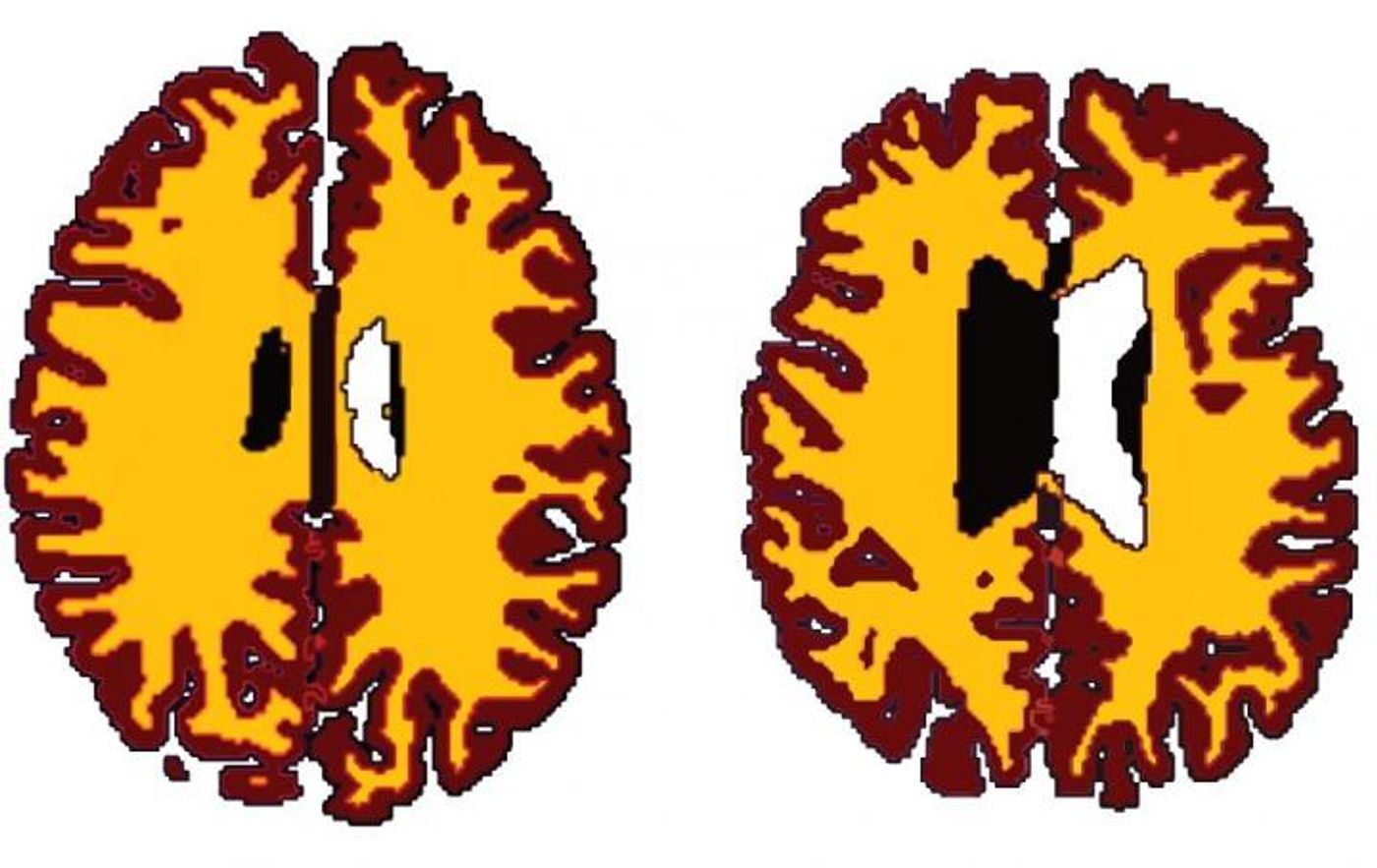 Brains of obese people 10 years older than lean counterparts | Image: Lisa Ronan