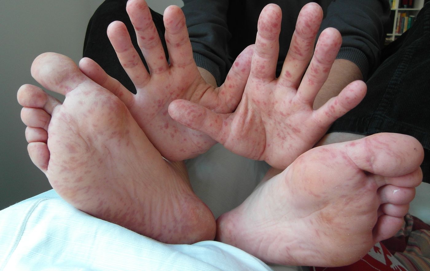 Why are college kids getting infected with hand, foot, and mouth disease? | Image: wikipedia.org