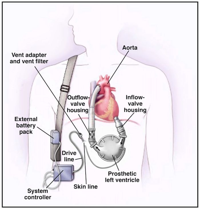 Pump Thrombosis - Is It On the Rise or Not? | Cardiology