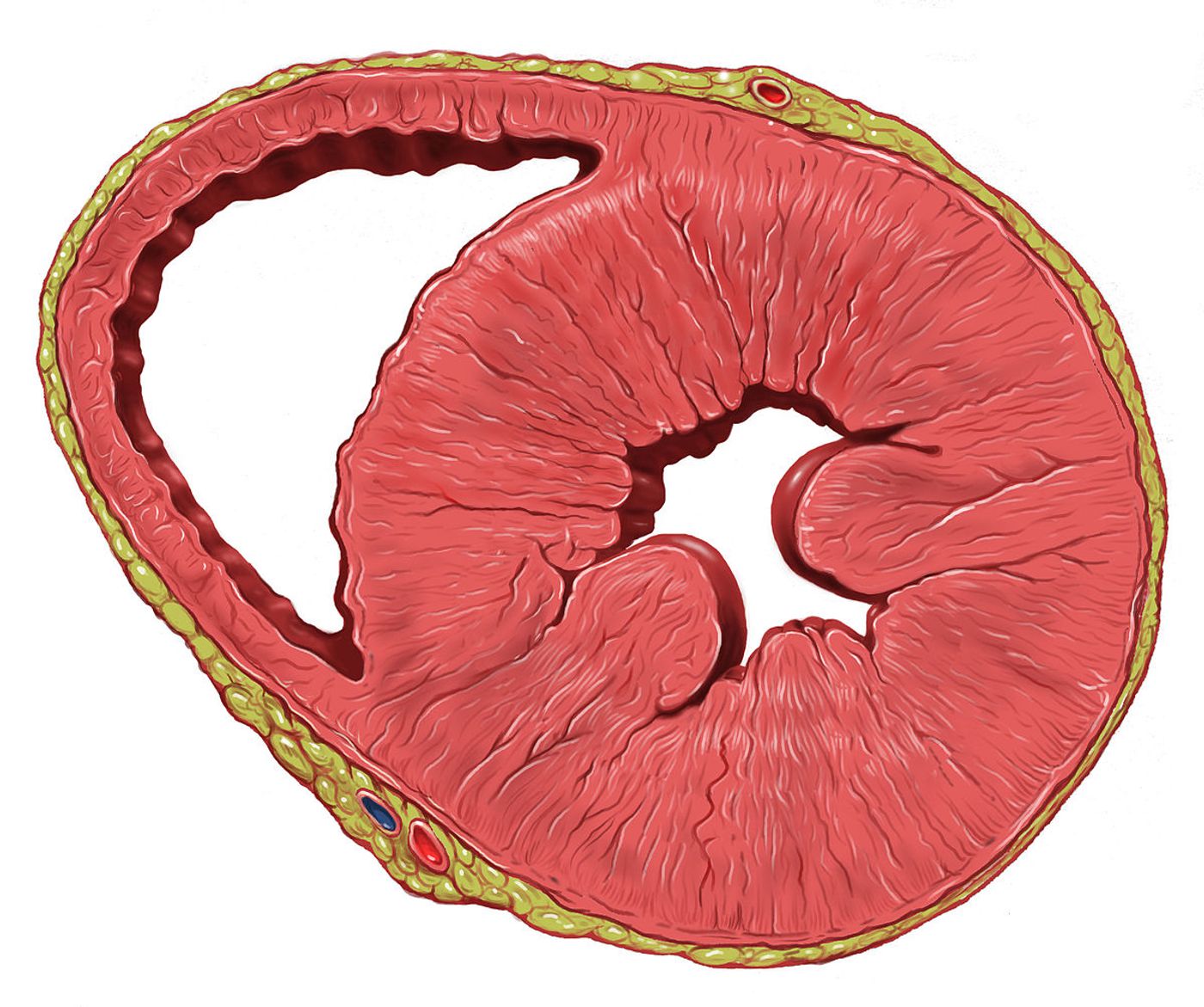 A heart with left ventricular hypertrophy in short-axis view.