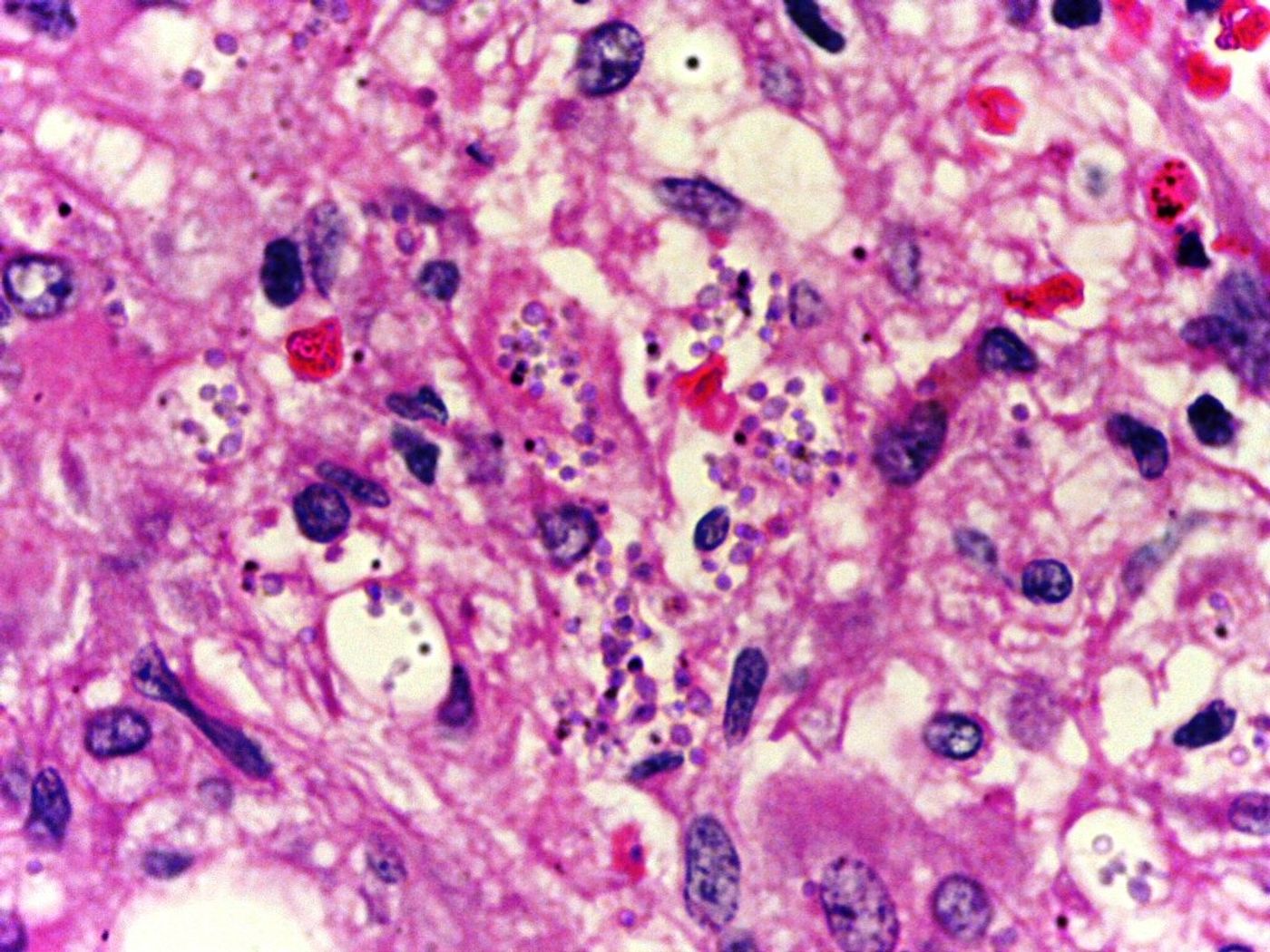 High power image of nuclei with amastigote forms of Leishmaniasis. Source: Calicut Medical COllege