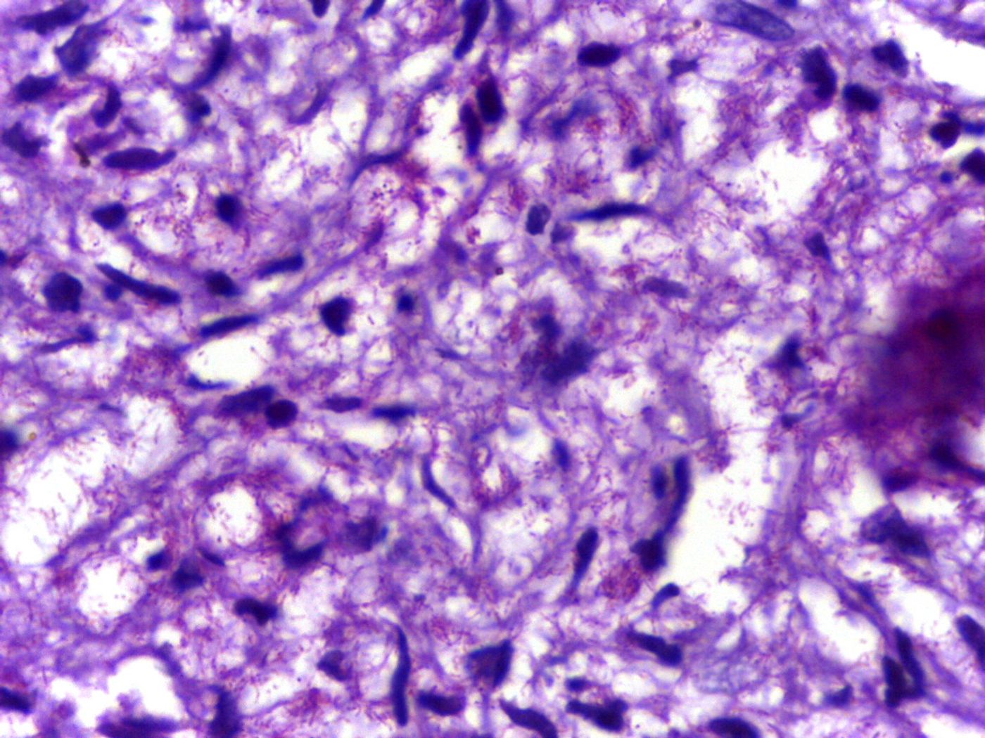Modified AFB staining in a case of lepromatous leprosy showing numerous rod shaped acid fast bacilli. Department of Pathology, Calicut Medical College