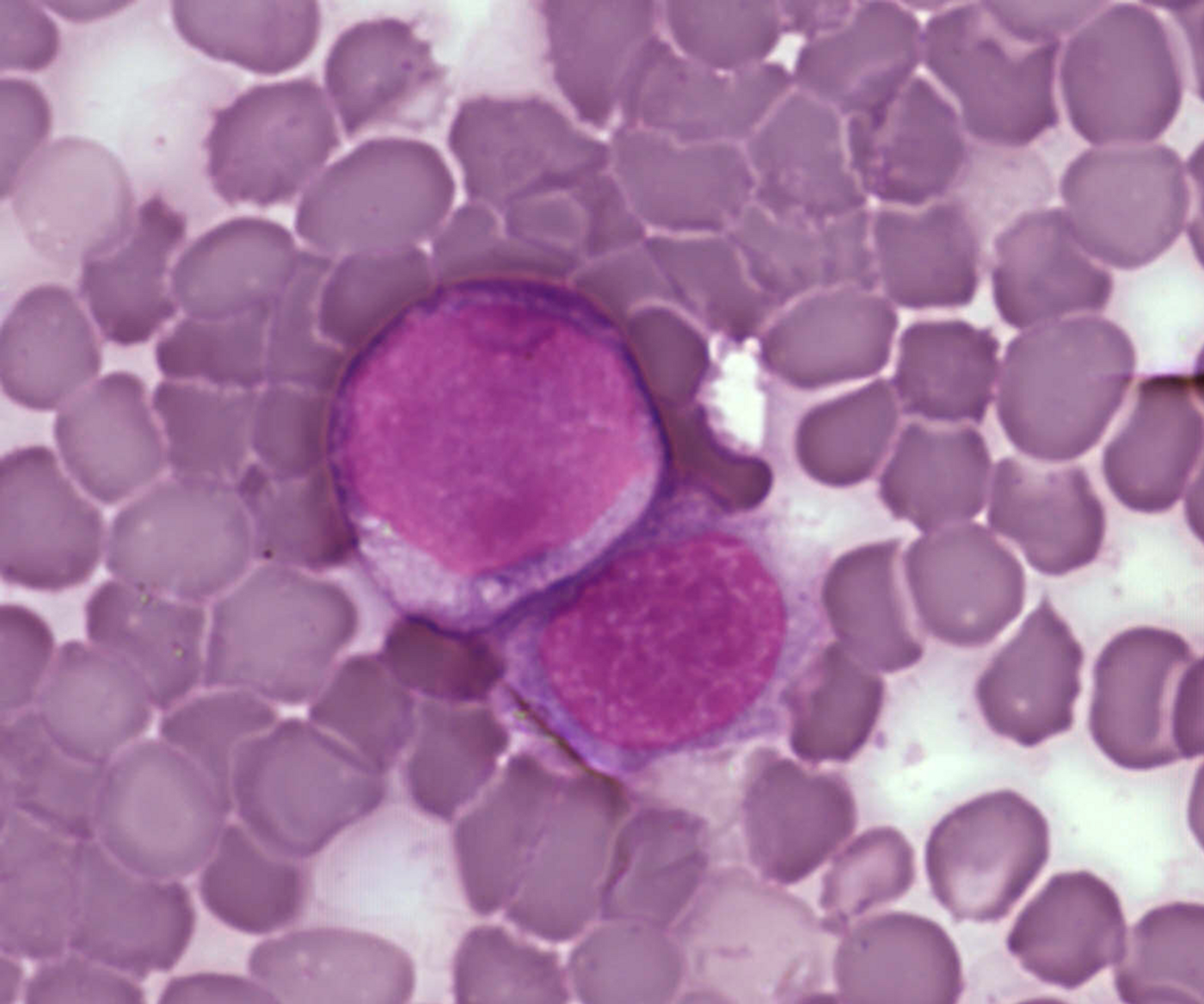 Leukemia cells. / Credit: A Surprising New Path to Tumor Development. PLoS Biol 3/12/2005 doi:10.1371/journal.pbio.0030433