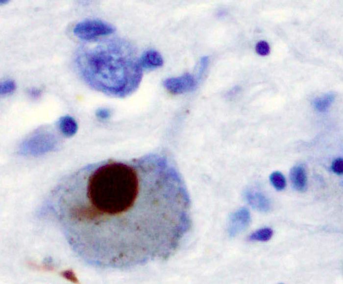 A lewy body stain showing Parkinson's Disease