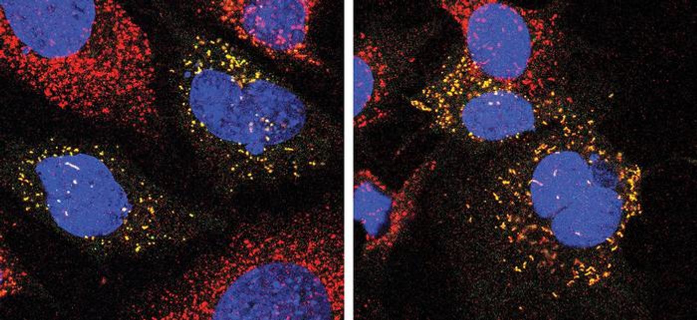 In the image on the left, recycling is normal in the cell. In the cell on right, recycling is disrupted and damaged peroxisomes (yellow) are not properly removed. / Credit: Kim-Bandsma lab/ The Hospital for Sick Children (SickKids).