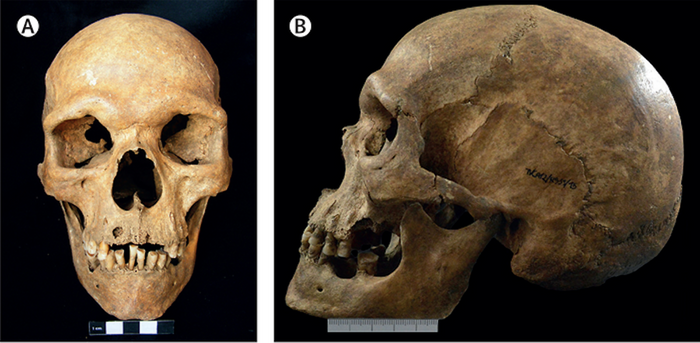 Photographs of the skull show anterior (A) and lateral (B) views with a probable malocclusion and maxillary prognathism showing atypical dental wear. / Credit: The Lancet