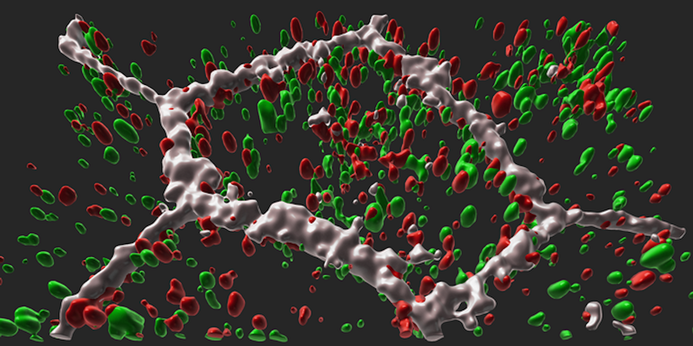 L-ORD patient RPE cell (white borders) with mutant protein CTRP5 (red) trapped inside the cell or in autophagosomes (green). / Credit: Ruchi Sharma and Davide Ortolan (NEI)