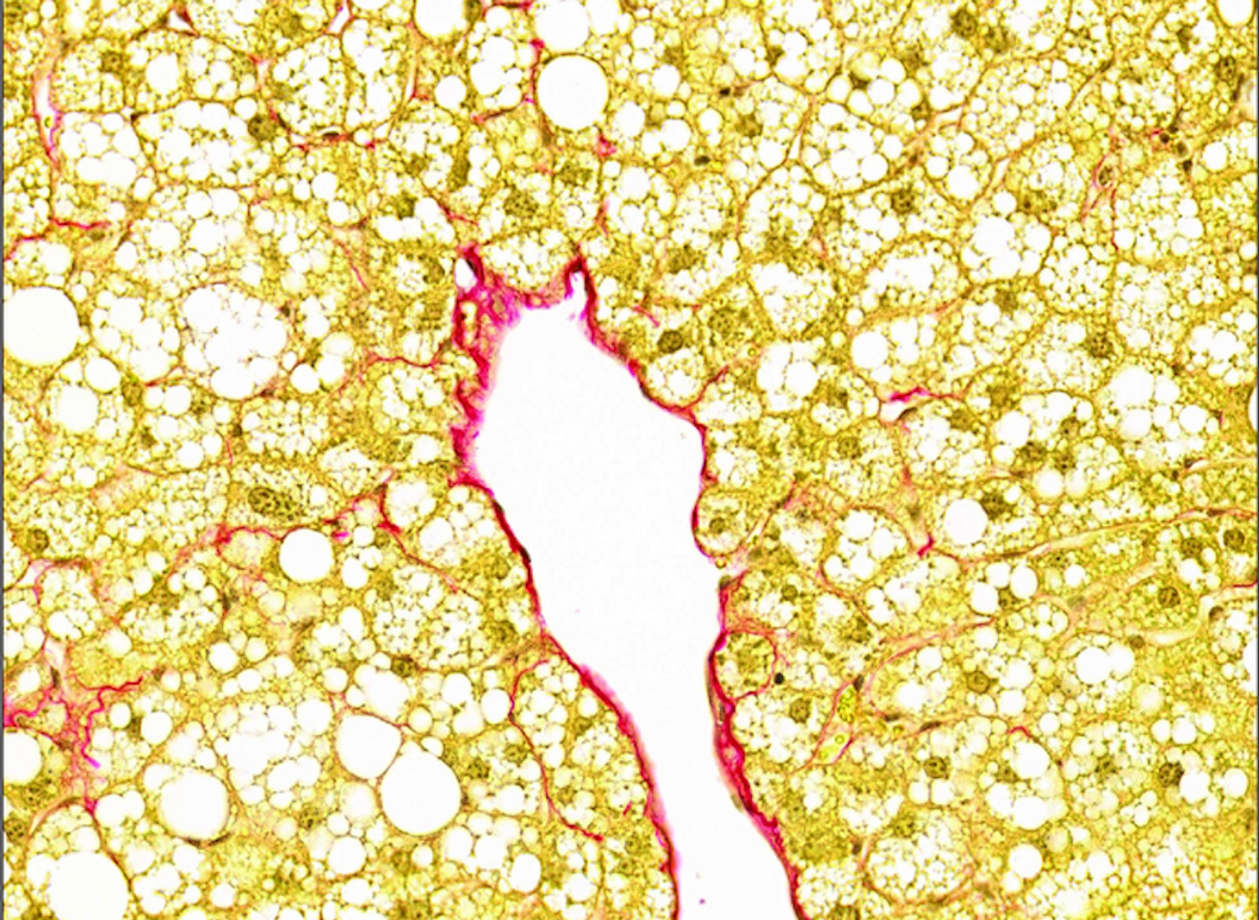 A diseased liver tissue sample with typical features. Fat-filled hepatocytes (yellow) and collagen build-up (red) display fibrosis and fatty liver disease. / Credit: WEHI