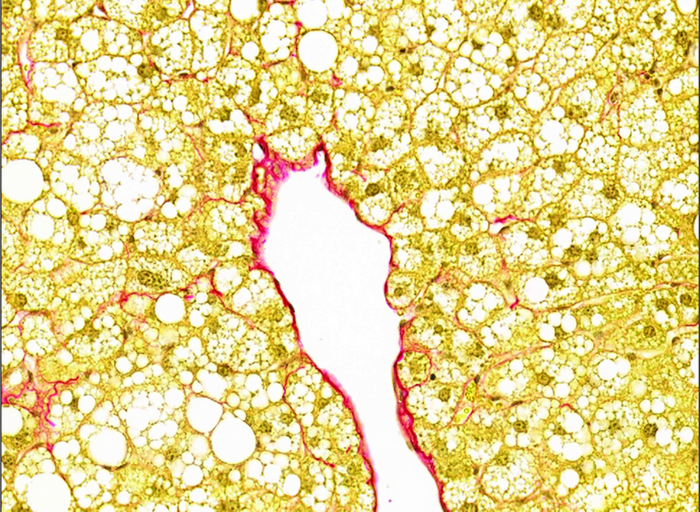 A diseased liver tissue sample with typical features. Fat-filled hepatocytes (yellow) and collagen build-up (red) display fibrosis and fatty liver disease. / Credit: WEHI