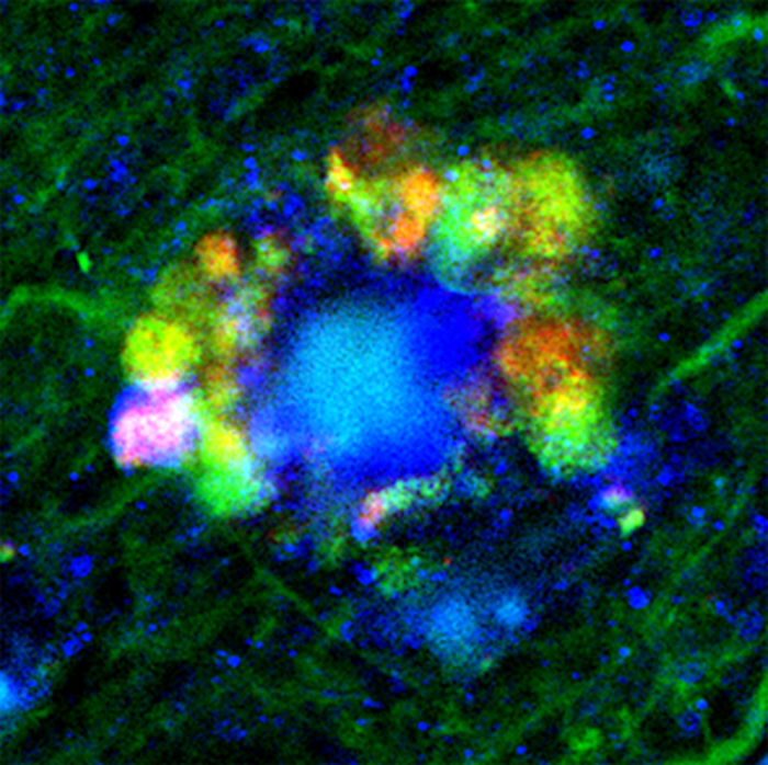 Fluorescent microscopy shows flower-like formations of autophagic vacuoles in neurons of an Alzheimer's disease mouse. / Credit  Courtesy of Springer-Nature Publishing.