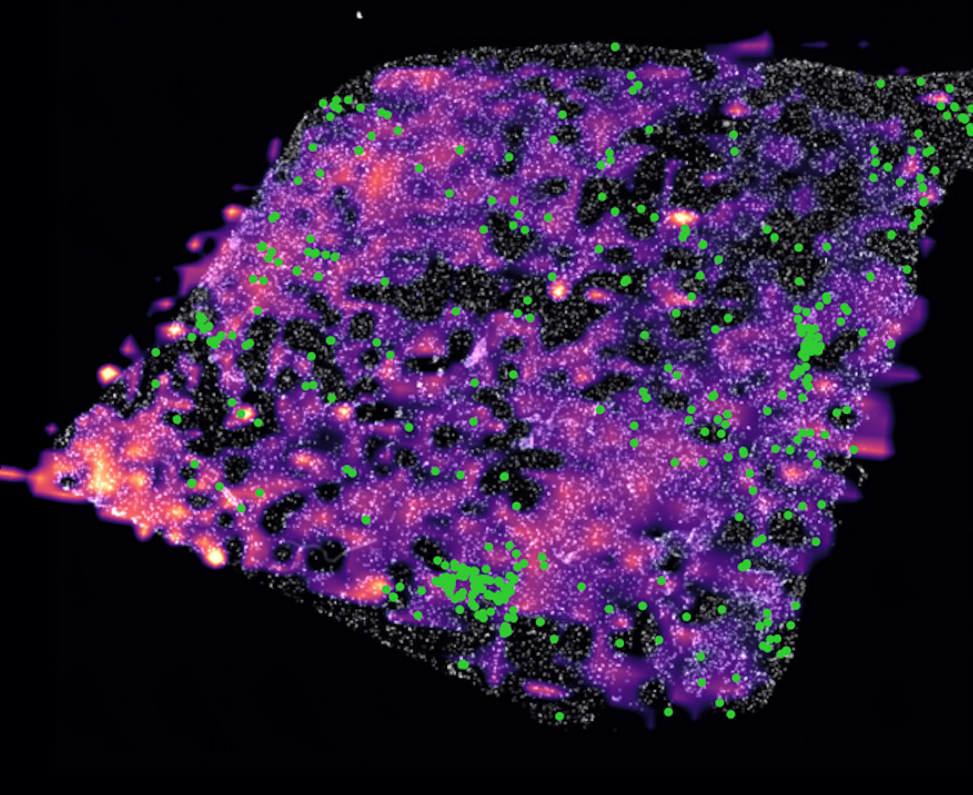 An IDH-mutant human glioma tumor, showing clusters of CD8+ T cells (green) and a gradient (purple to pink) representing low to high D-2HG concentrations. D-2HG and CD8+ T levels are inversely correlated. / Image credit: Gregory Baker, HMS