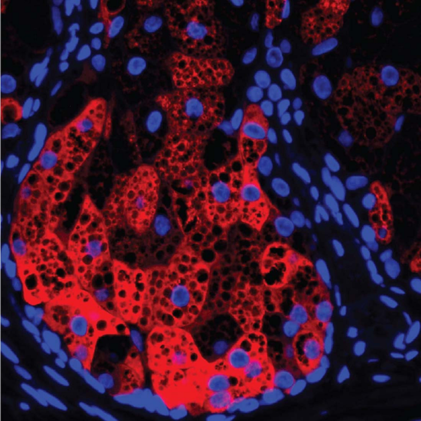 HSD3B1 (red) within a human sebaceous gland, cell nuclei (blue), and lipid droplets (black circular areas). / Credit: UT Southwestern Medical Center