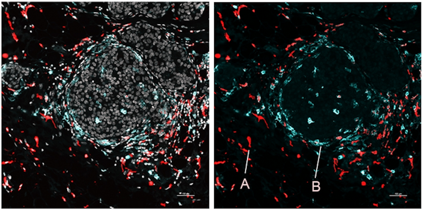 Image of human breast cancer cells showing A) immunosuppressive macrophages near tumor connective tissue, and B) immunostimulatory macrophages near tumor nests. / Credit: Nir Ben Chetrit.