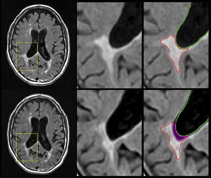 Representative example of an atrophied ('disintegrating') lesion. Top row shows baseline MRI images, and bottom row shows follow-up MRI images. The magenta region in the bottom right panel shows the part of the original lesion (top) that has disintegrated into cerebrospinal fluid over the intervening period. Nearly 20 percent of the lesion was lost over time. / Credit: Michael G. Dwyer