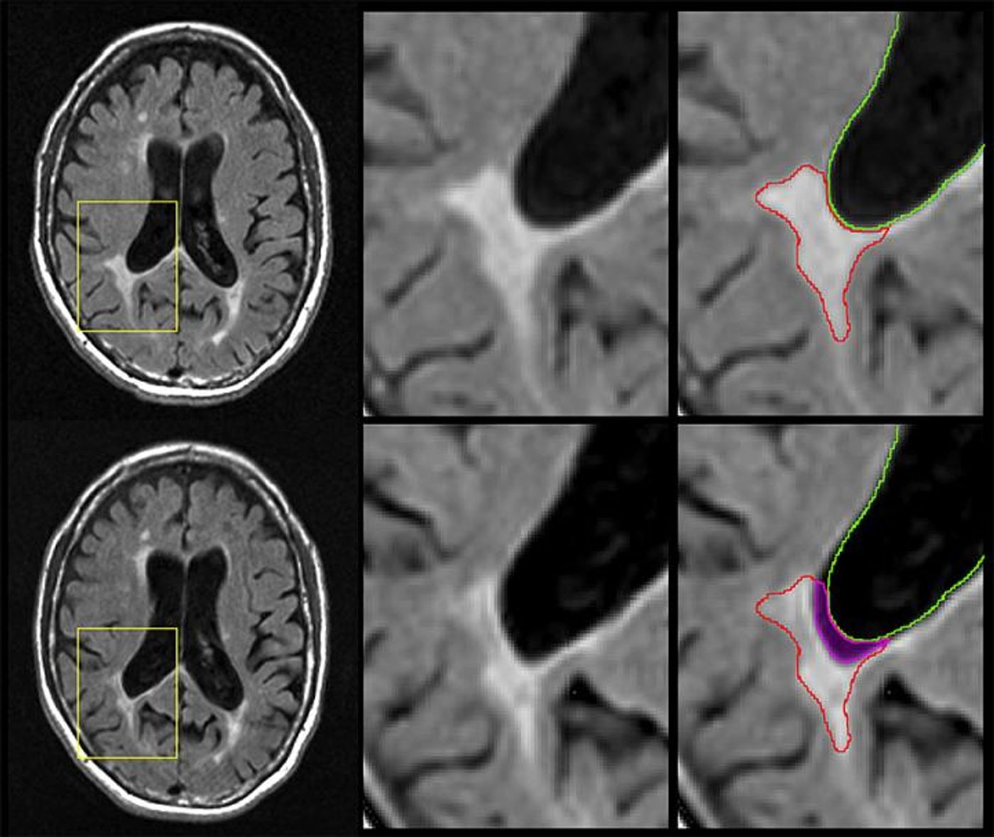 Representative example of an atrophied ('disintegrating') lesion. Top row shows baseline MRI images, and bottom row shows follow-up MRI images. The magenta region in the bottom right panel shows the part of the original lesion (top) that has disintegrated into cerebrospinal fluid over the intervening period. Nearly 20 percent of the lesion was lost over time. / Credit: Michael G. Dwyer