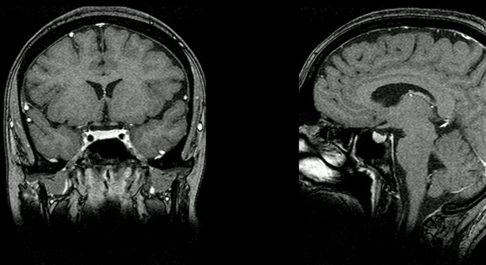 MRI / Credit: Wikimedia/Forma39