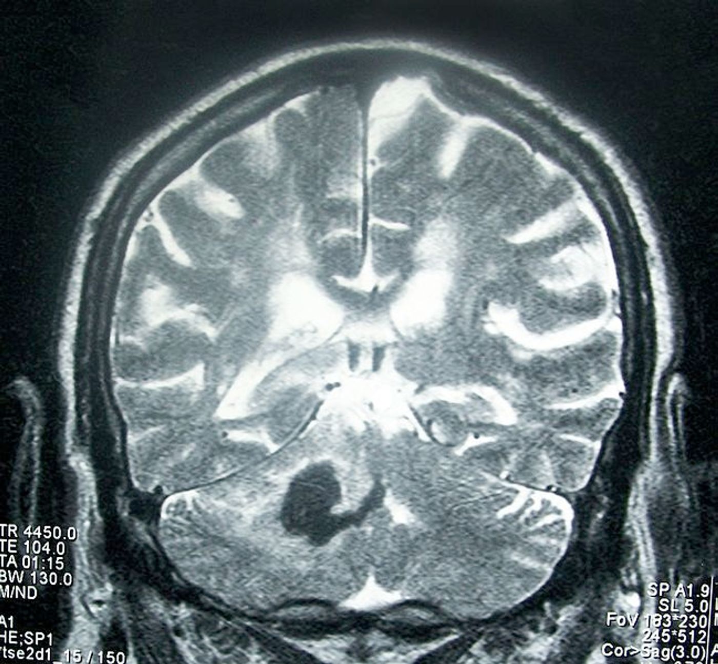 Head MRI showing deep intracerebral hemorrhage (cerebellum). Credit: WIkimedia User Bobjgalindo