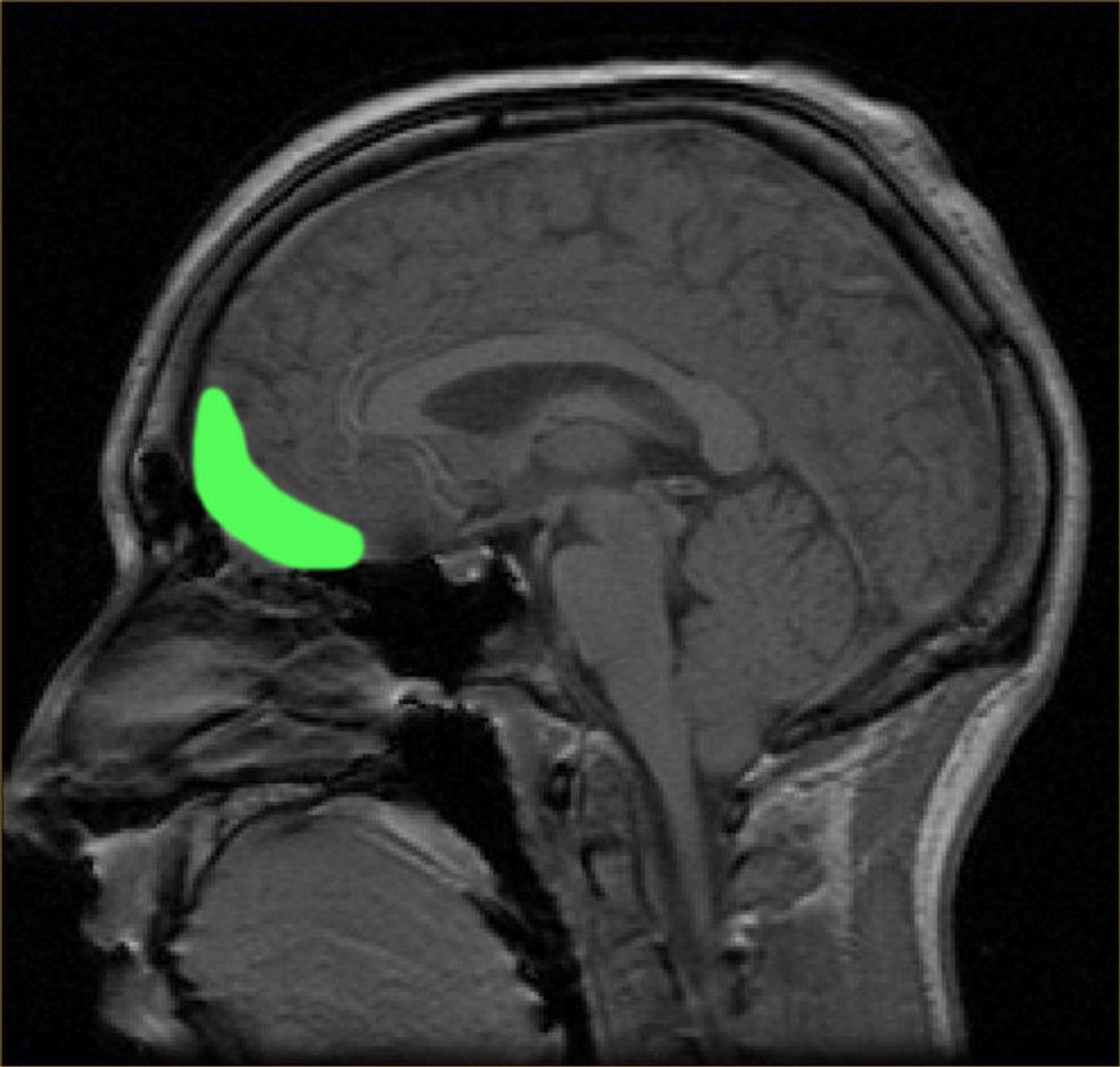 MRI image, orbitofrontal cortex is labeled in green.