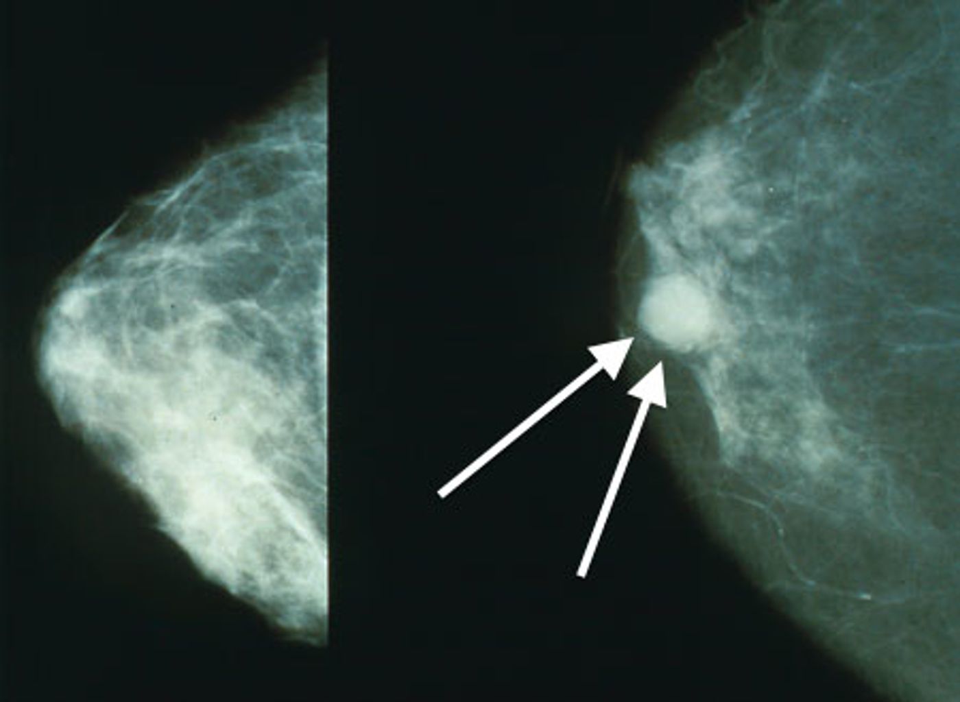 Normal (left) versus cancerous (right) mammography image.