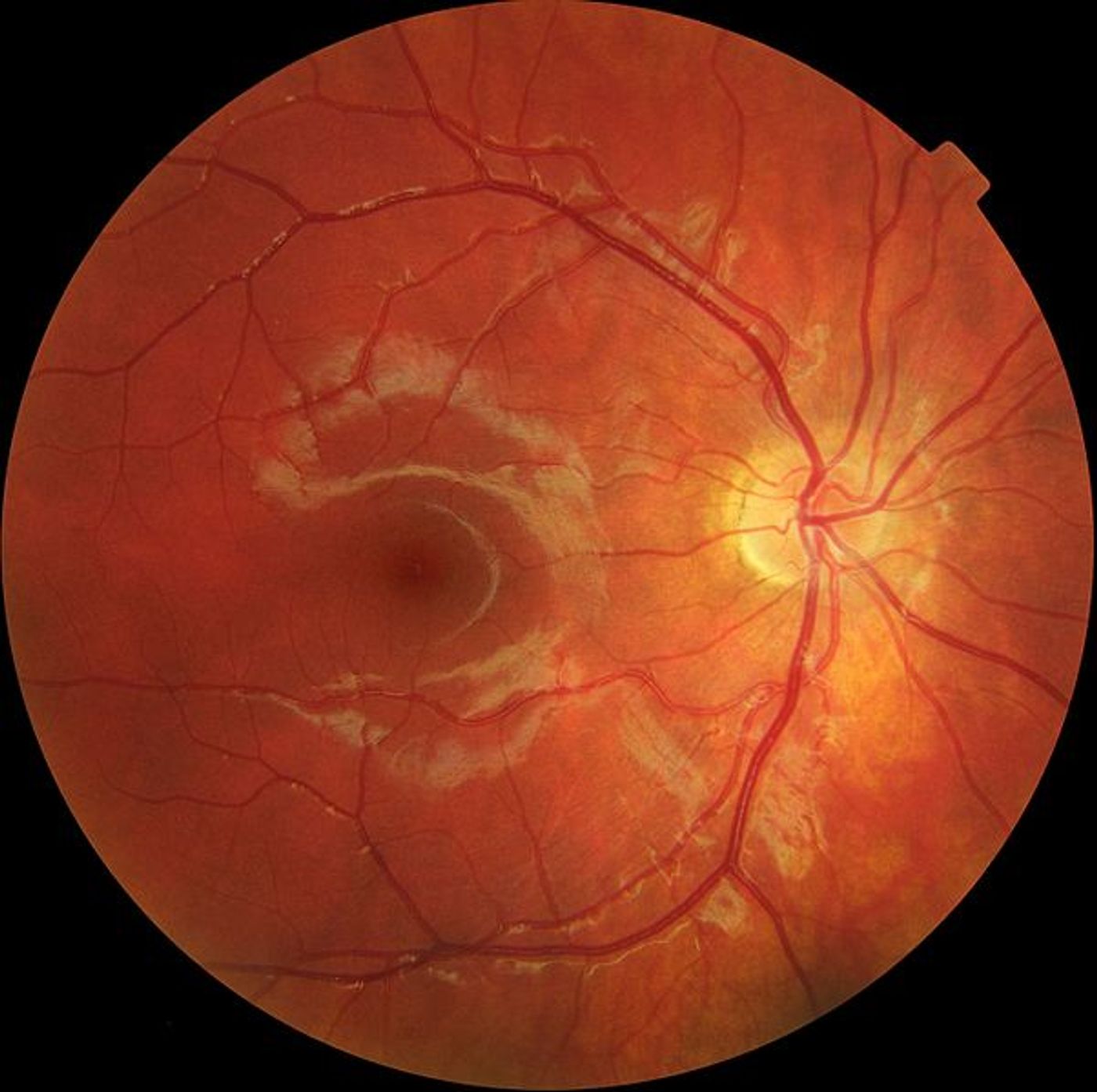 Macular degeneration. Credit: Ralf Roletschek