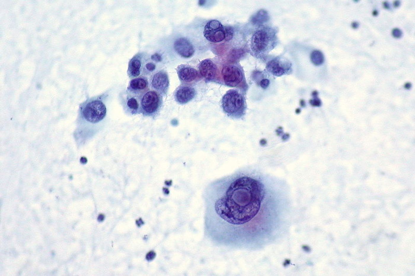 A liver FNA biopsy of malignant melanoma. Credit: Ed Uthman